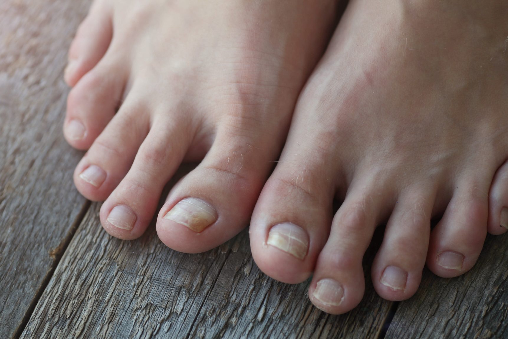 Шершавые ногти на ногах